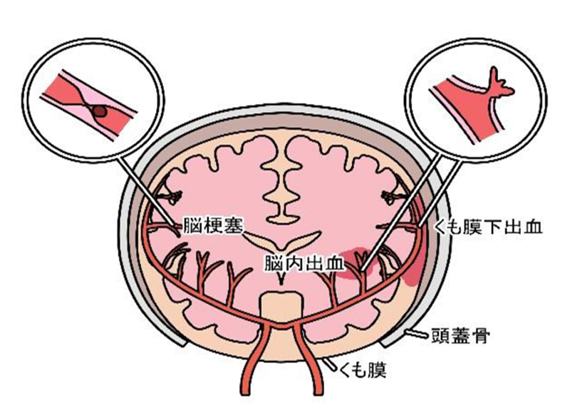頭痛の原因2